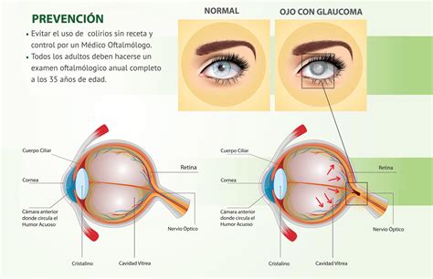 glaucoma que es - o que é hemangioma
